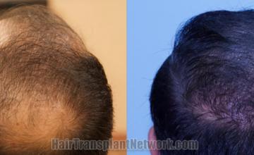  before and after result photographs