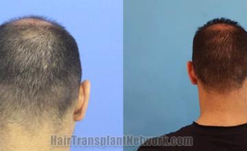 Back view before and after hair transplantation photos