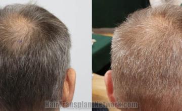 Back view before and after hair transplantation ,