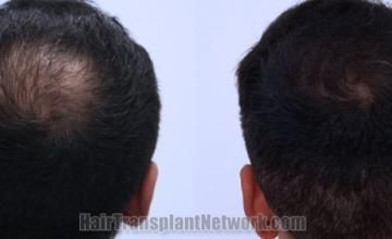 Back view before and after hair transplantation 