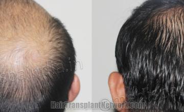 Back view before and after hair transplantation 