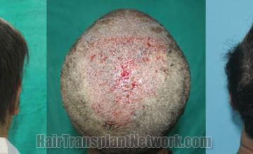 Surgical hair transplantation result photographs