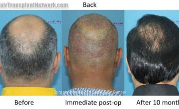 Surgical hair transplantation result photographs