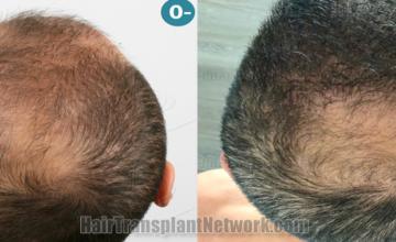  before and after result photographs