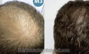  before and after result photographs