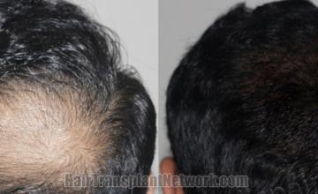 Back view before and after hair transplantation 