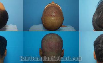 Surgical hair transplantation result photographs