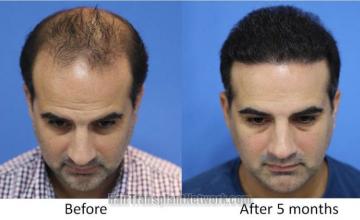 Before and after hair restoration procedure images