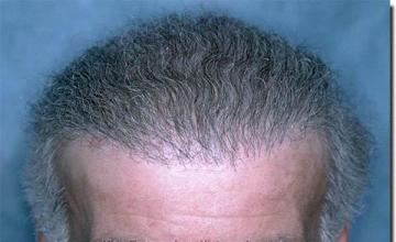 Hair restoration procedure results