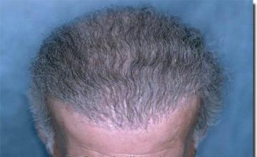 Hair restoration procedure results