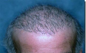 Hair restoration procedure results