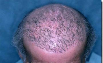 Hair restoration procedure results