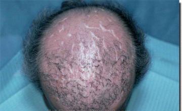 Hair restoration procedure results