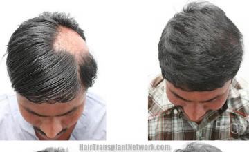 Hair restoration procedure before and after results