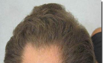 Hair restoration procedure results