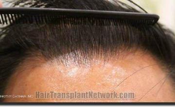 Hair restoration procedure results