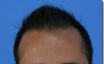 Hair restoration procedure results