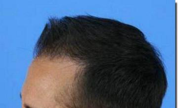 Hair restoration procedure results