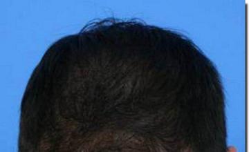 Hair restoration procedure results