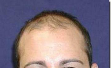 Hair restoration procedure results