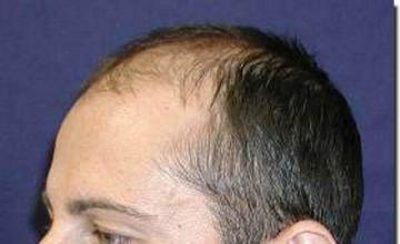 Hair restoration procedure results