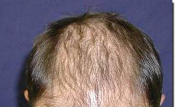 Hair restoration procedure results