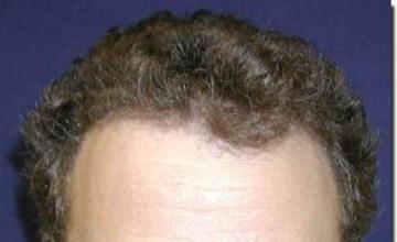 Hair restoration procedure results