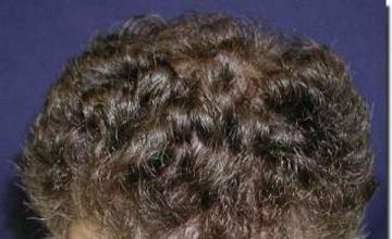 Hair restoration procedure results