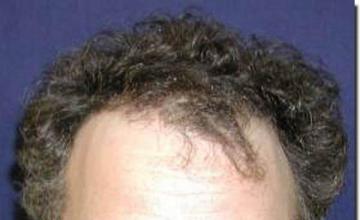 Hair restoration procedure results