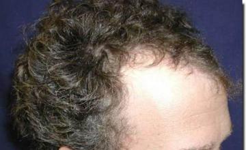 Hair restoration procedure results