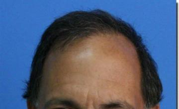 Hair restoration procedure results