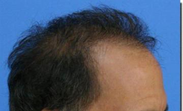 Hair restoration procedure results