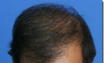 Hair restoration procedure results