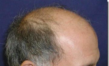 Hair restoration procedure results