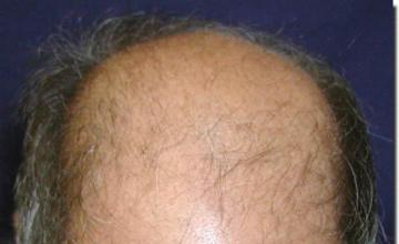 Hair restoration procedure results