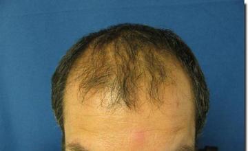 Hair restoration procedure results