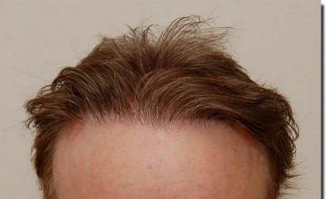 Hair restoration procedure results