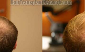 Hair restoration procedure before and after pictures