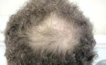 Before and after hair transplant procedure images