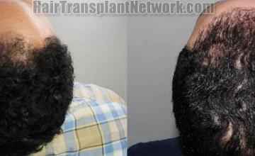 Hair restoration procedure before and after pictures