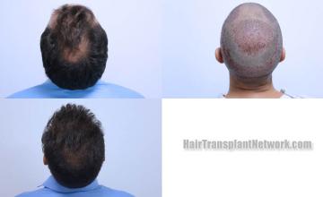 Surgical hair transplantation result photographs