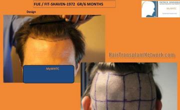 Hair transplant surgery before and after photos