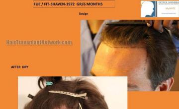 Hair restoration procedure before and after results