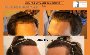 Hair restoration procedure before and after results