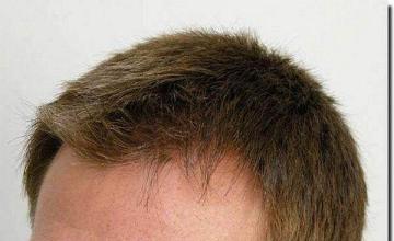 Hair restoration procedure results