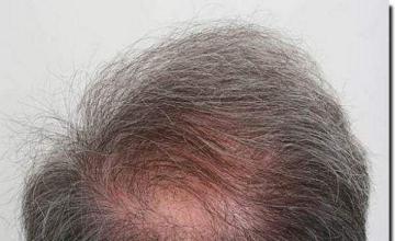 Hair restoration procedure results