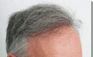 Hair restoration procedure results