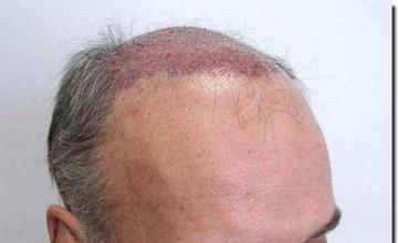 Hair restoration procedure results