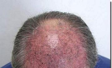 Hair restoration procedure results