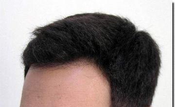 Hair restoration procedure results